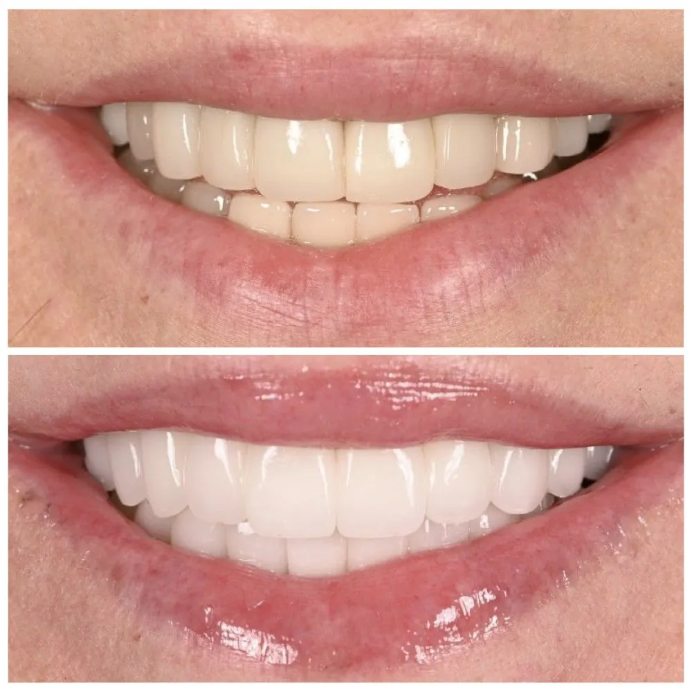 Porcelain veneers before (top) and after (bottom), case 26, Dr. Andi-Jean Miro at Apa Aesthetic