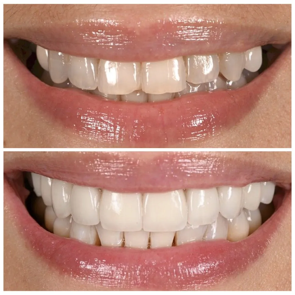 Porcelain veneers before (top) and after (bottom), case 27, Dr. Andi-Jean Miro at Apa Aesthetic