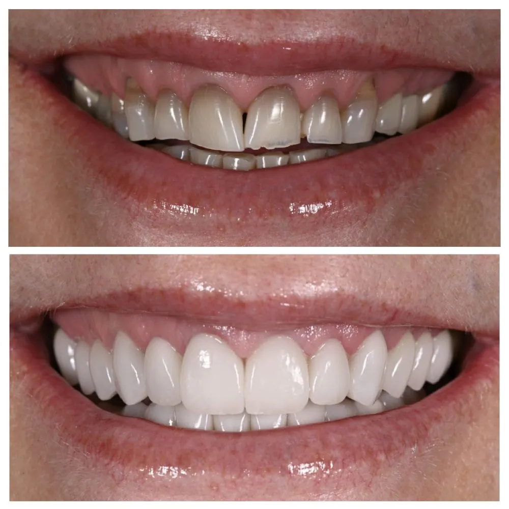 Wendy's smile before (top) and after (bottom) treatment with Dr. Andi-Jean Miro