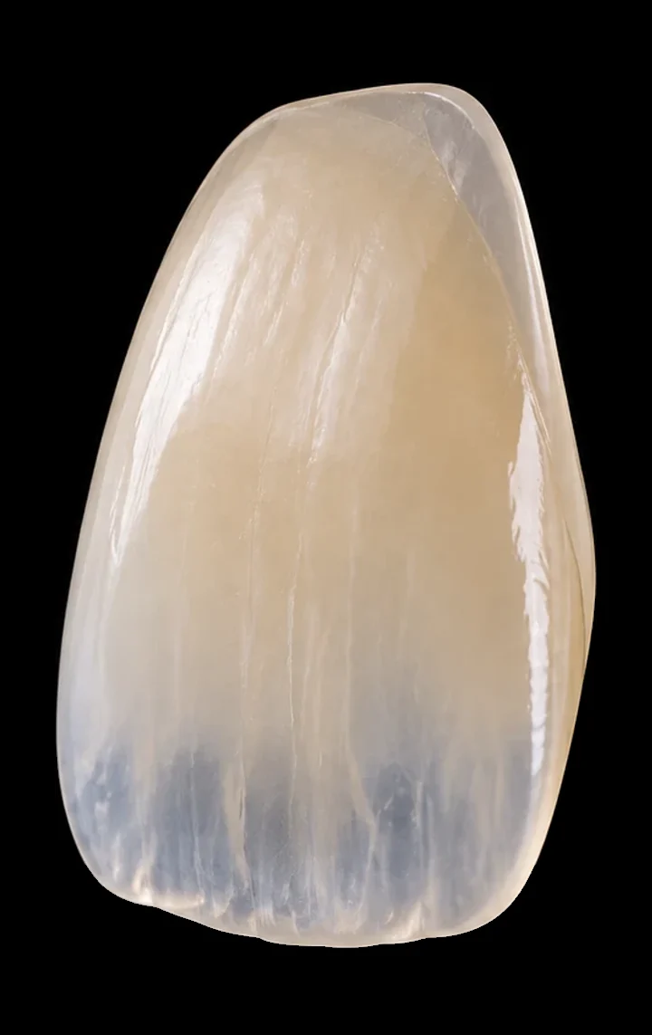 A hand-layered porcelain veneer for an upper front tooth