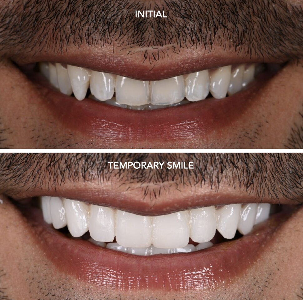 Veneer design and temporaries