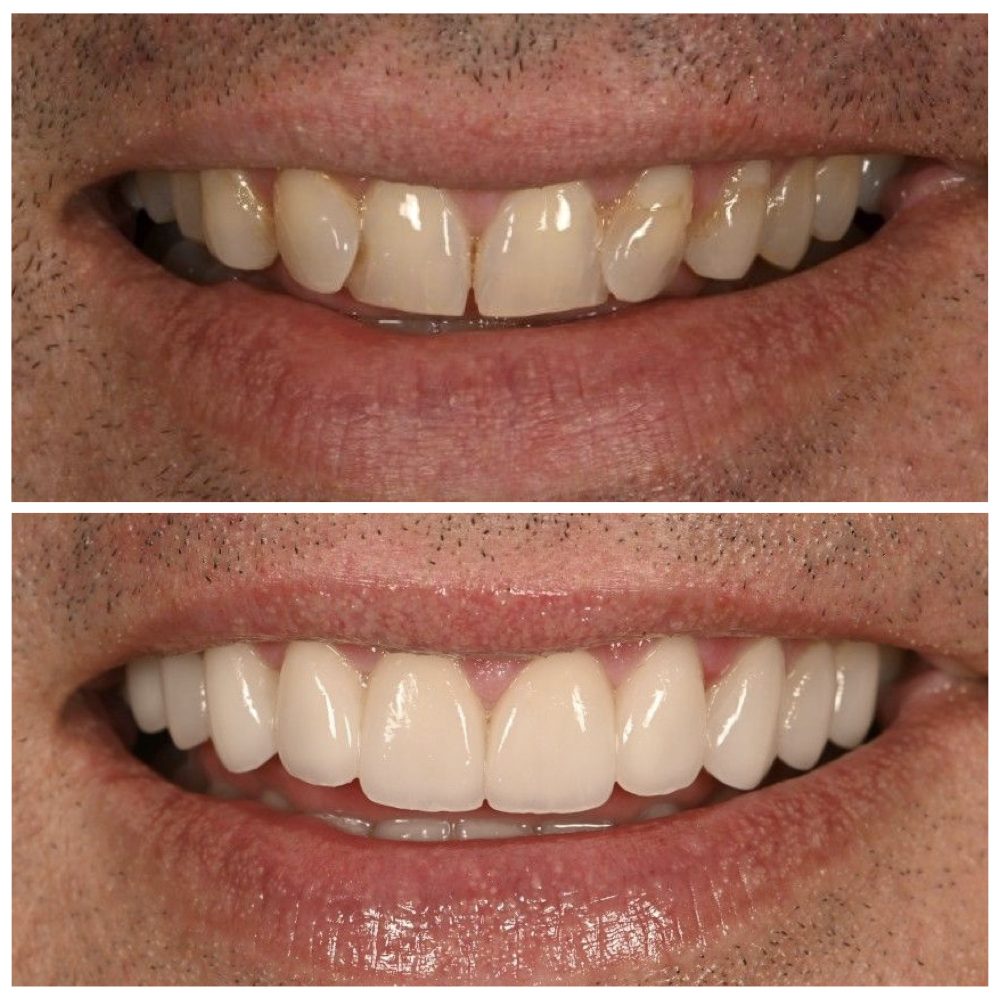Mike — smile transformation