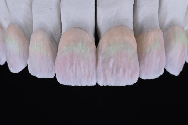 Smile makeover story