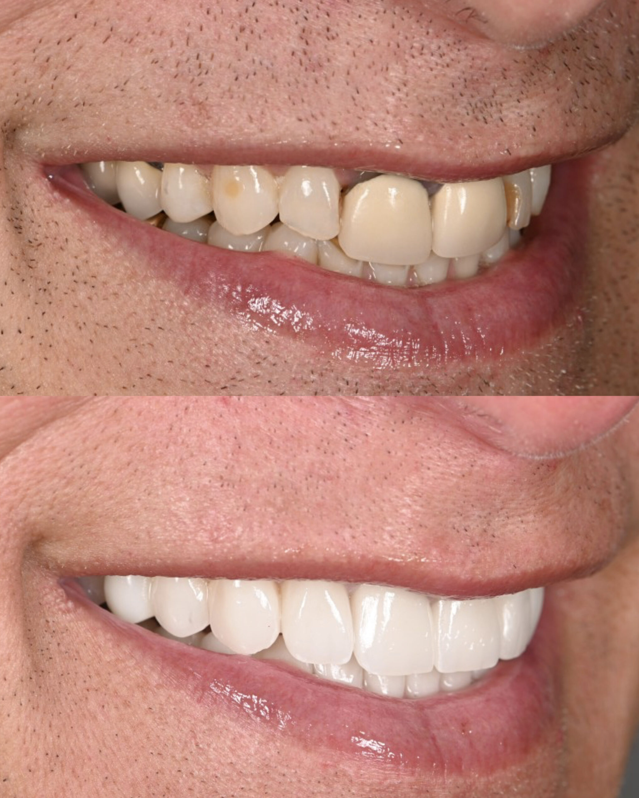 Side smile view before and after restoring worn, discolored teeth — actual patient of Dr. Andi-Jean Miro