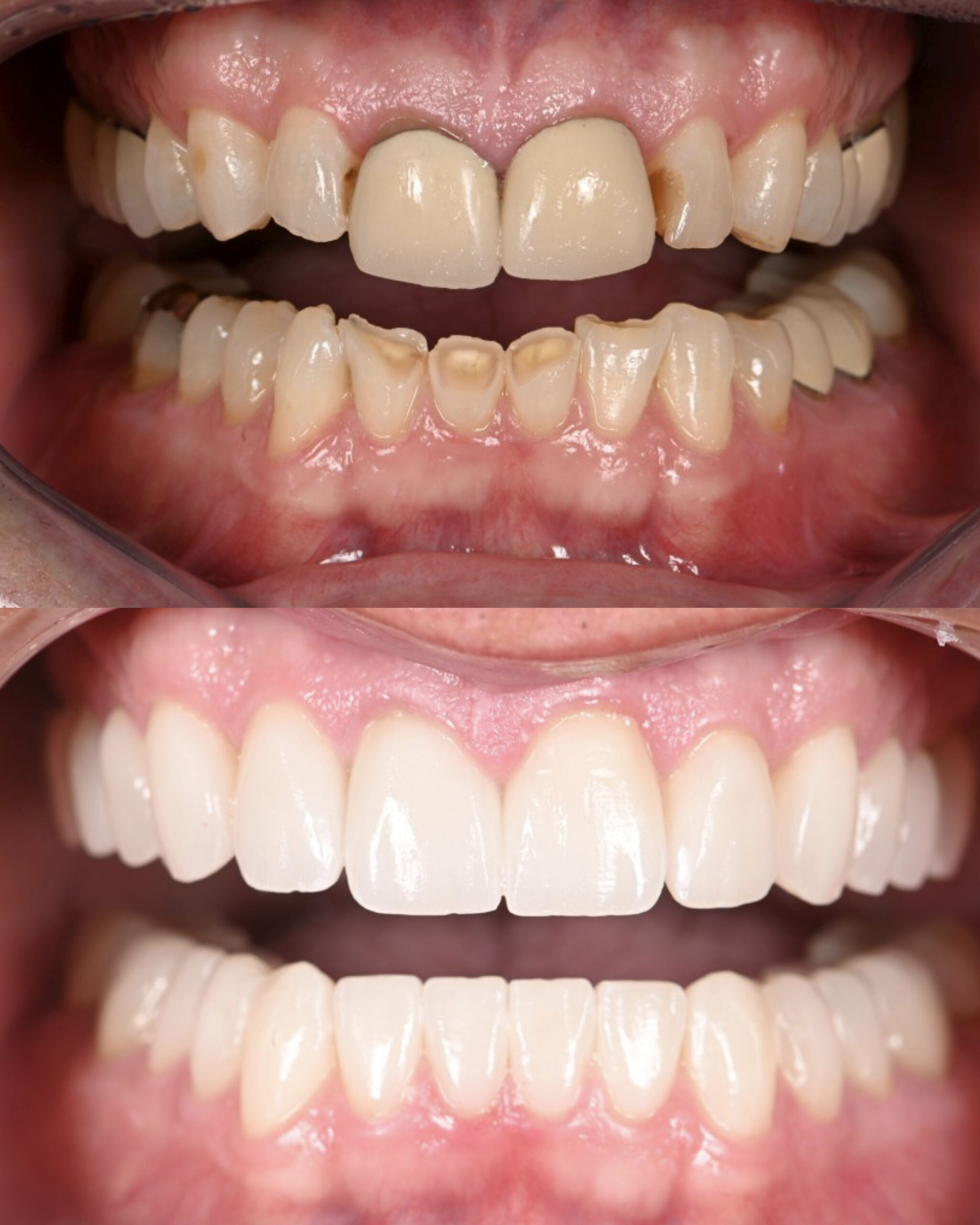 Retracted view before and after a full upper and lower restoration of worn teeth — actual patient of Dr. Andi-Jean Miro