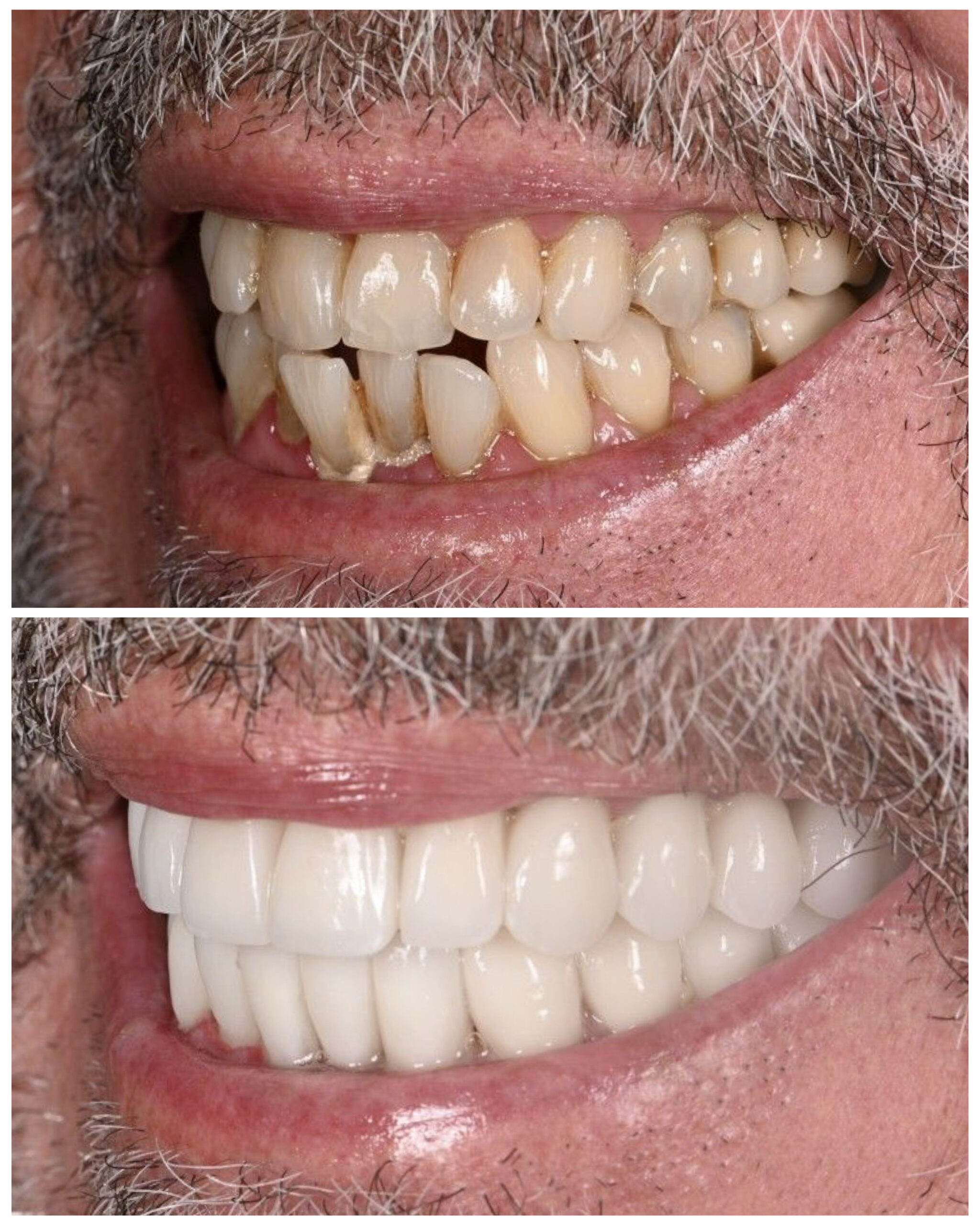 Before and after smile makeover, profile smile view — actual patient of Dr. Andi-Jean Miro